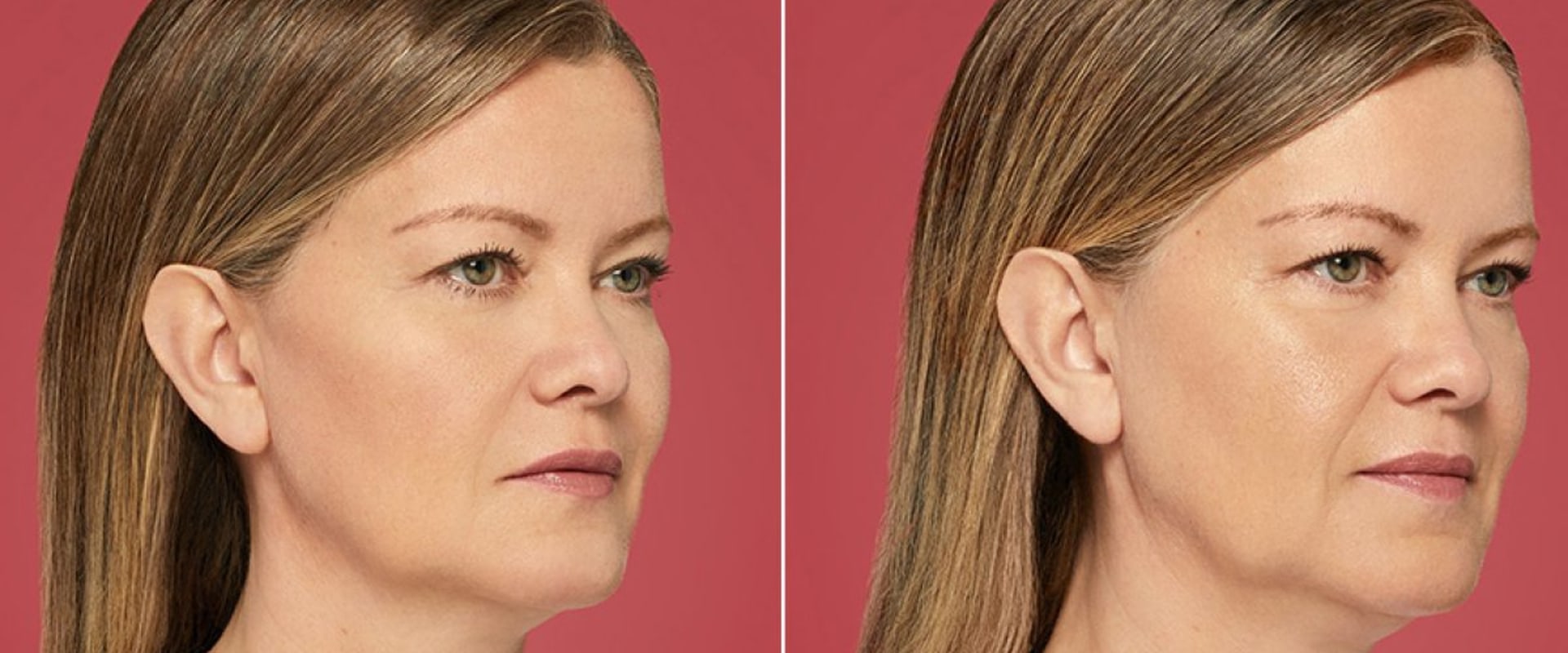 The Best Natural Fillers for a Youthful Look
