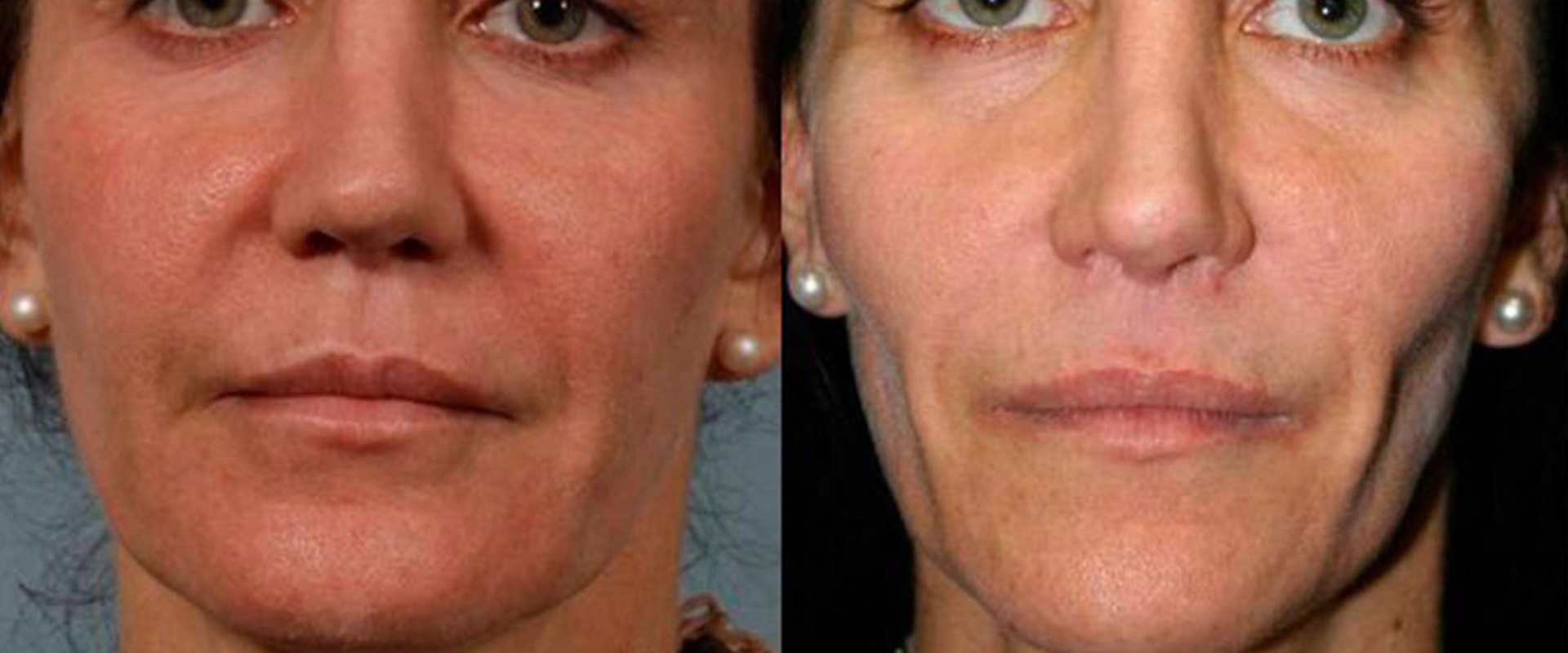 What happens when fillers go away?