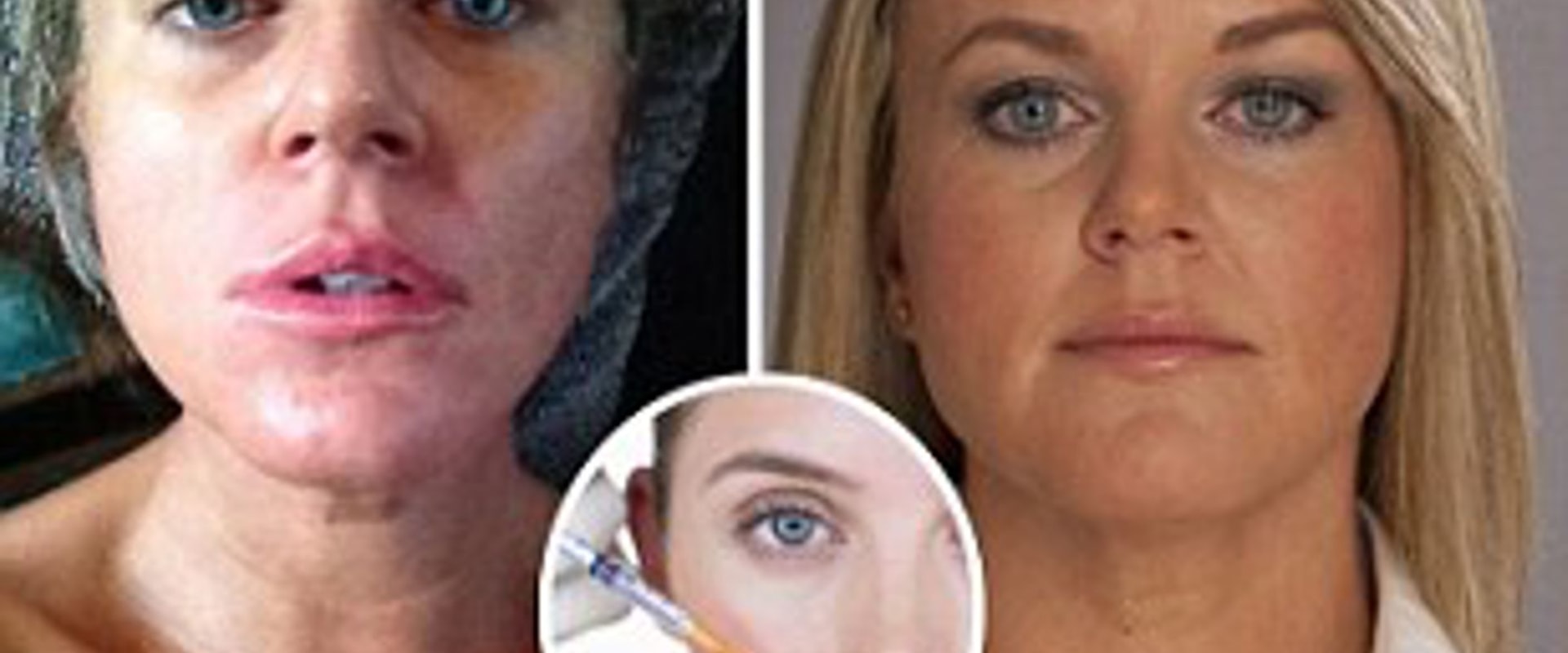 Are Face Fillers Safe? A Comprehensive Guide