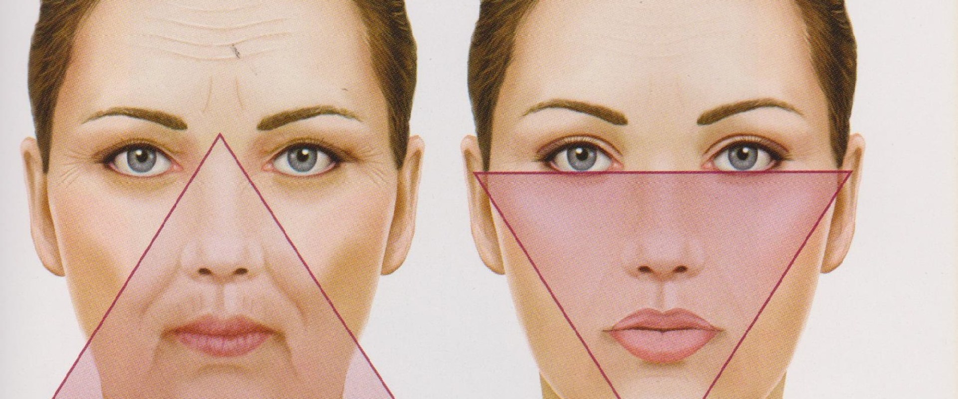 Where Should Cheek Fillers Go? A Comprehensive Guide