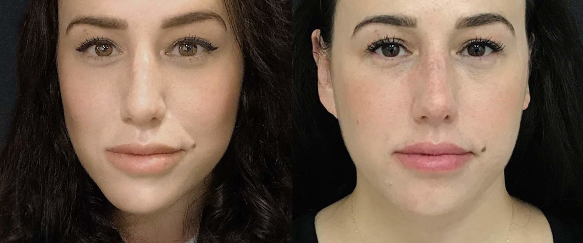 Which Filler is Best for Lips and Cheeks?