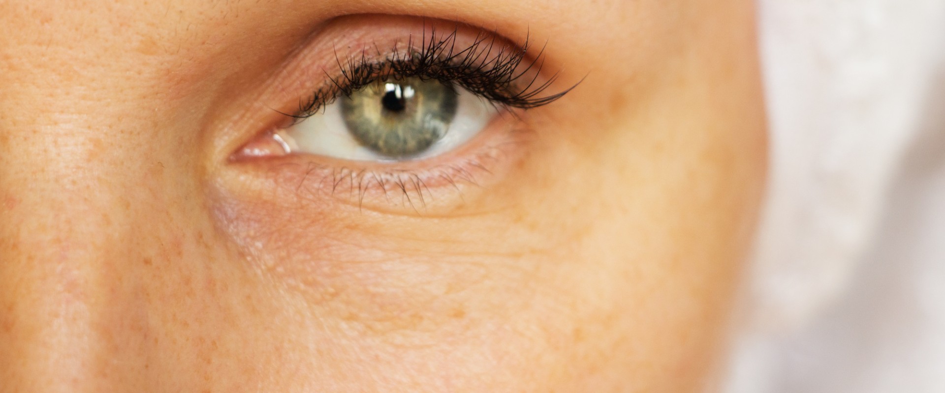 Do under eye fillers prevent aging?