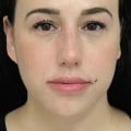 Which filler can be used in both lips and cheeks?