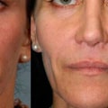 What does filler do to your face?