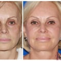 Revitalize Your Look: Facial Fillers in New York City