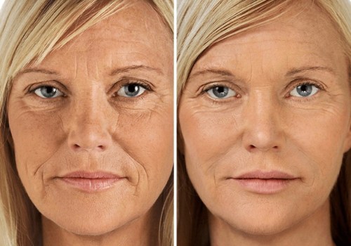 Fountain of Youth Med Spa: Is Facial Filler Worth It?