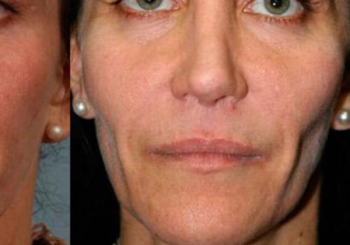 How long does it take for face fillers to work?