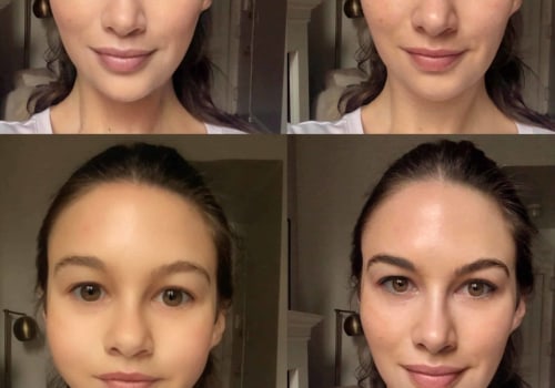 Do fillers change the look of your face?