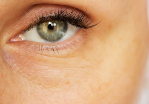 Do Under Eye Fillers Stop Aging?